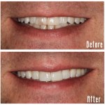 Before and after smile Case #10