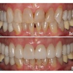 Before and after smile Case #1