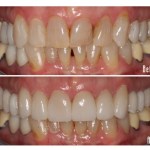 Before and after smile Case #1