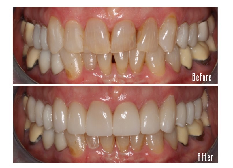 Before and after smile Case #1