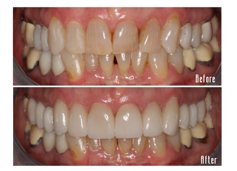Before and after smile Case #1