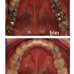 Before and after smile Case #2