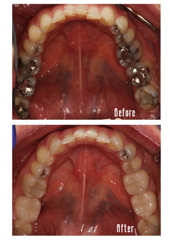 Before and after smile Case #2