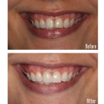 Before and after smile Case #7
