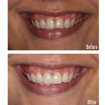 Before and after smile Case #7