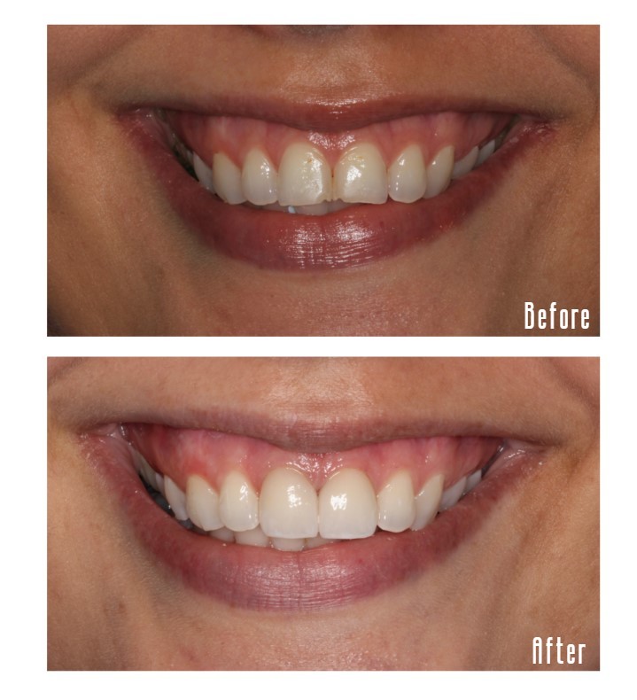 Before and after smile Case #7