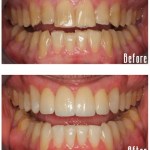 Before and after smile Case #11