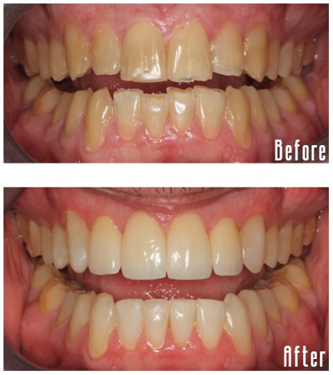 Before and after smile Case #11