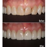 Before and after upper teeth Case #1