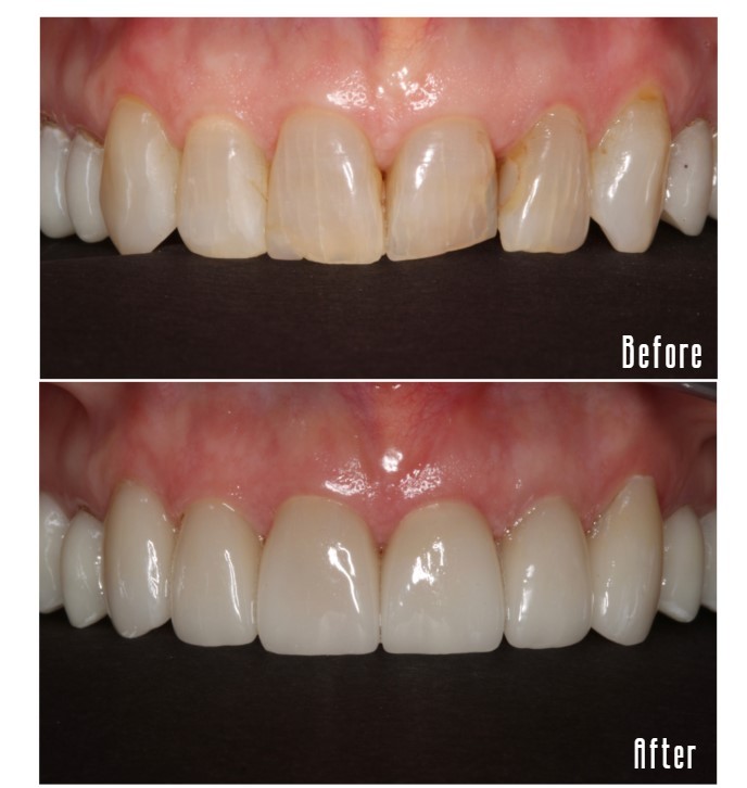 Before and after upper teeth Case #1