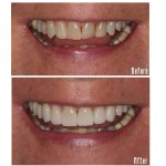 Before and after smile Case #8