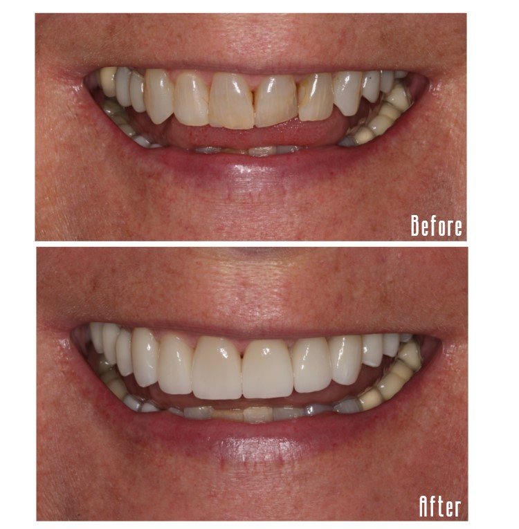 Before and after smile Case #8