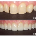 Before and after upper teeth Case #2
