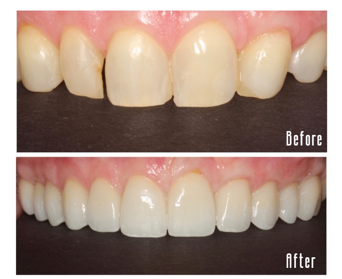 Before and after upper teeth Case #2