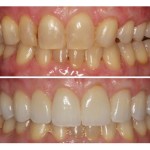 Before and after smile Case #3
