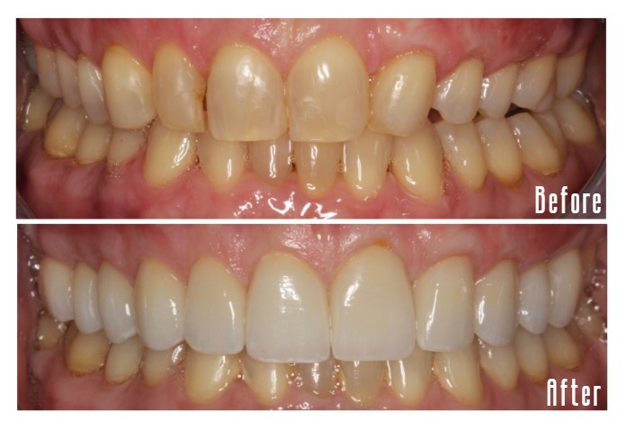 Before and after smile Case #3