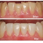 Before and after lower teeth Case #1