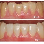 Before and after lower teeth Case #1