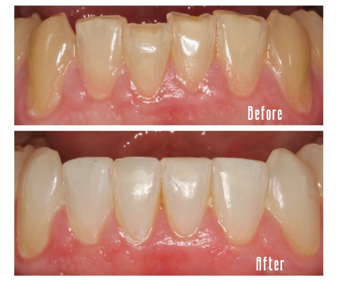 Before and after lower teeth Case #1