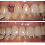 Before and after smile Case #6