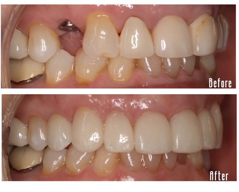 Before and after smile Case #6