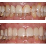 Before and after smile Case #4
