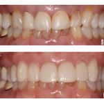 Before and after smile Case #4