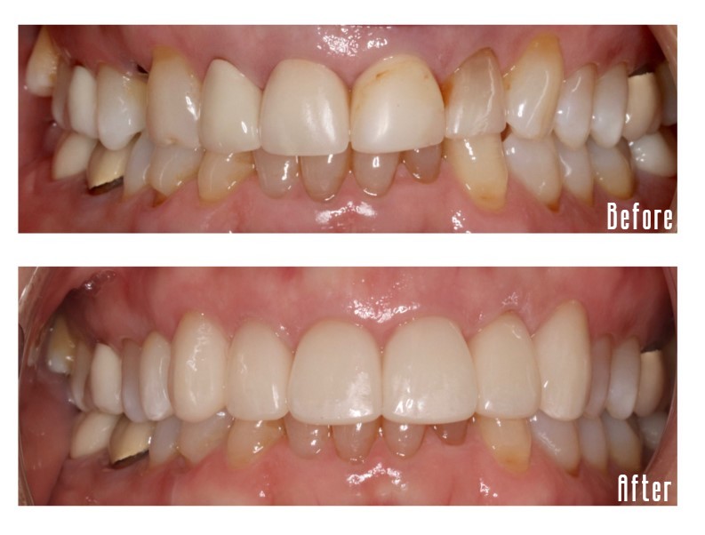 Before and after smile Case #4