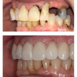 Before and after smile Case #5 