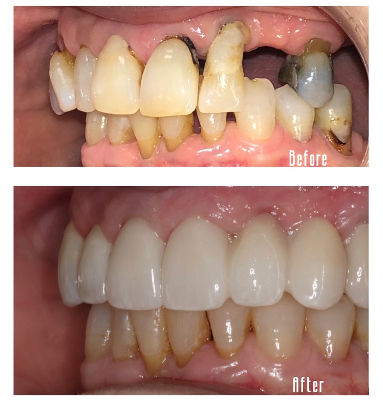 Before and after smile Case #5 