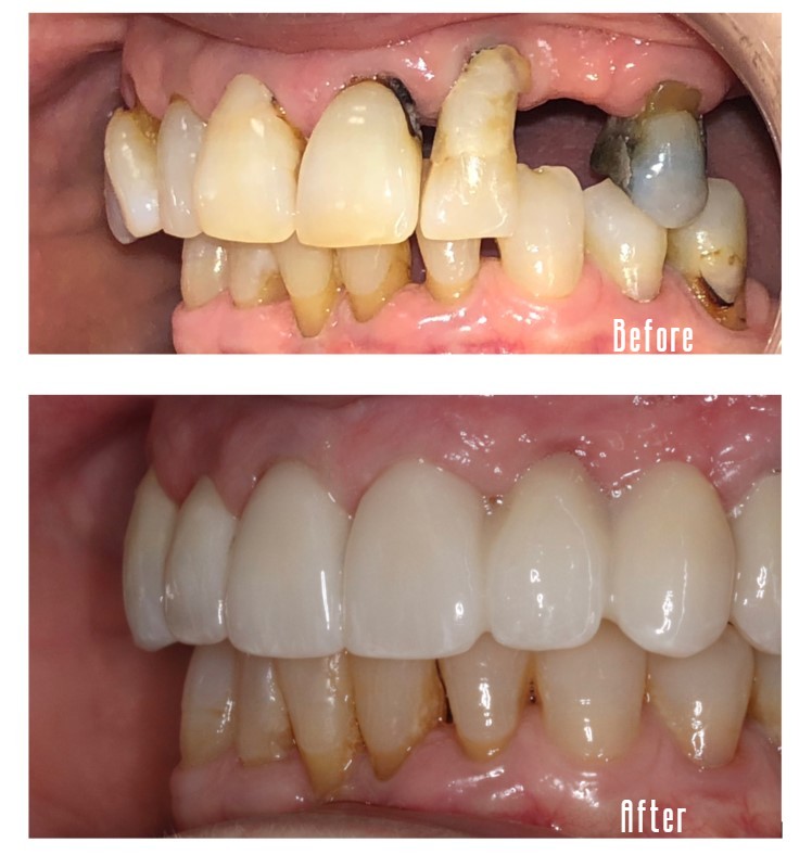 Before and after smile Case #5
