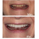 Before and after smile Case #9